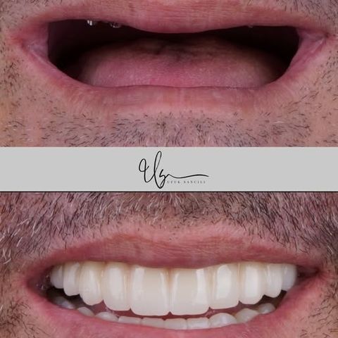 Tam ağız rehabilitasyonu vakası – Instagram @dt.ufuksancili