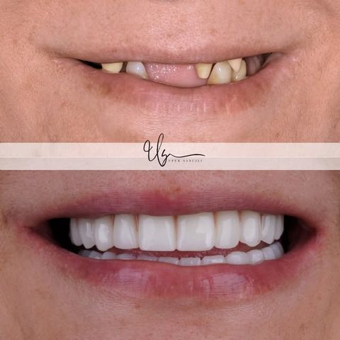 Estetik restorasyon vakası – Instagram @dt.ufuksancili