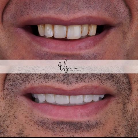 Gülüş tasarımı vakası – Instagram @dt.ufuksancili